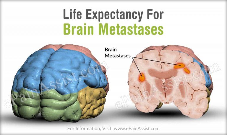 Life Expectancy For Brain Metastases