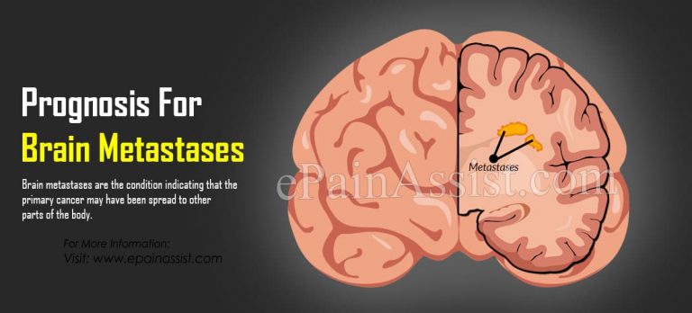 Prognosis For Brain Metastases