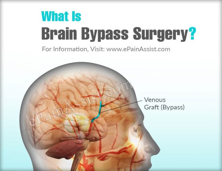 What Is Brain Bypass Surgery?