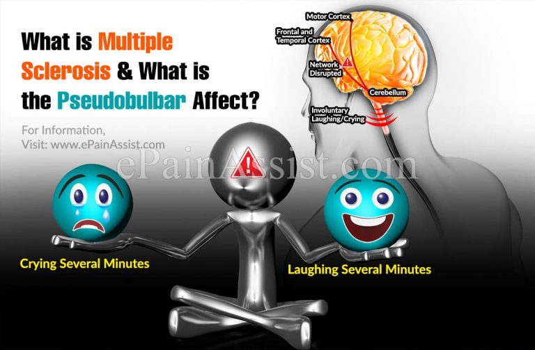 Pseudobulbar Affect and Multiple Sclerosis