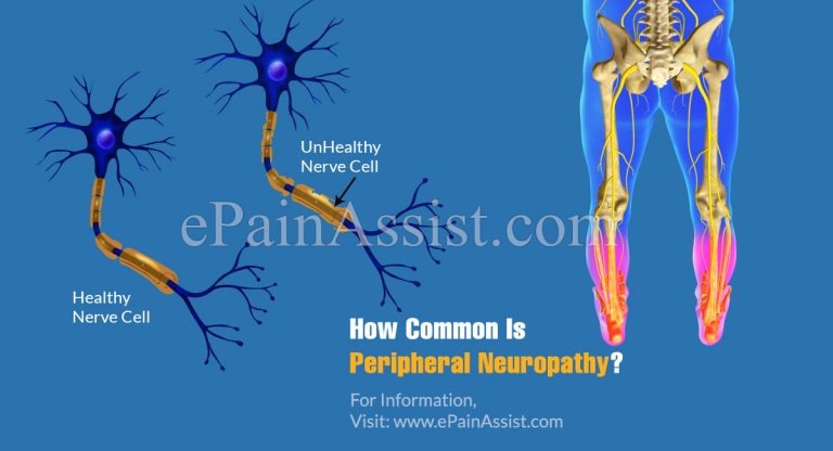 How Common Is Peripheral Neuropathy or Is It A Rare Disease?