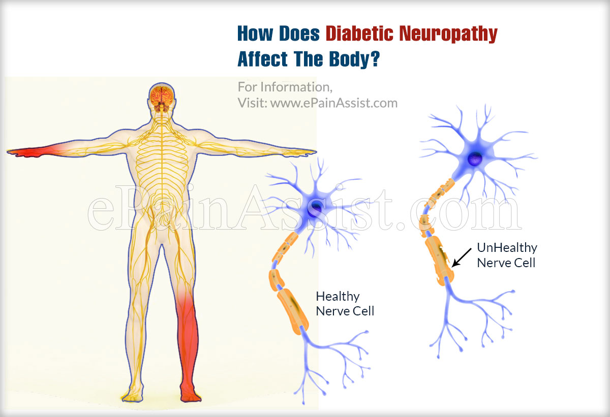 How Does Diabetic Neuropathy Affect The Body?