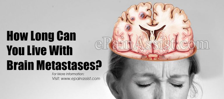 How Long Can You Live With Brain Metastases?