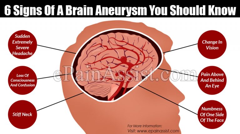 6 Signs Of A Brain Aneurysm You Should Know