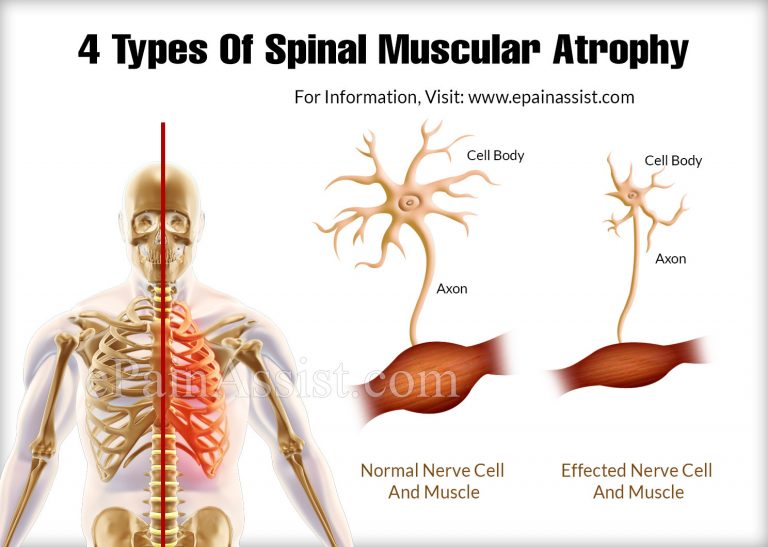 4 Types Of Spinal Muscular Atrophy