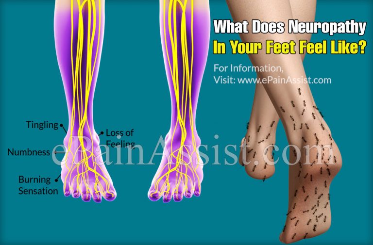 What Does Neuropathy In Your Feet Feel Like?