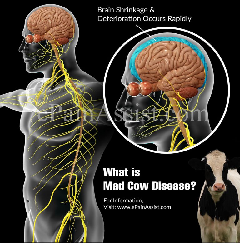 What is Mad Cow Disease & How Does It Affect Humans? | Symptoms & Treatment of Mad Cow Disease