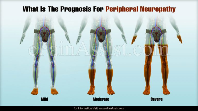 What Is The Prognosis For Peripheral Neuropathy?