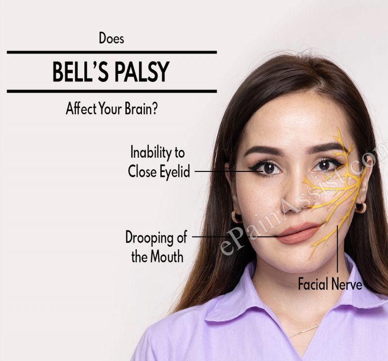 Does Bell’s Palsy Affect Your Brain & Why Does My Eye Water With Bell’s Palsy?