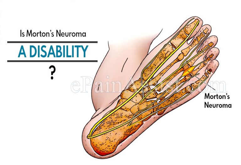 Is Morton’s Neuroma A Disability?