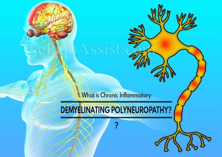 Role Of The Immune System In Chronic Inflammatory Demyelinating Polyneuropathy