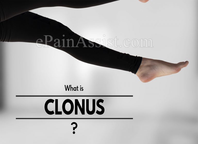 What is Clonus: Causes, Diagnosis, Treatment, Outlook