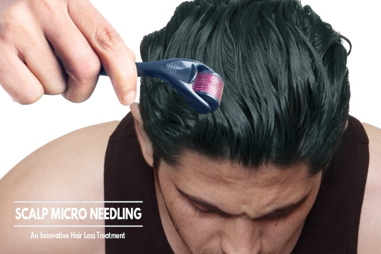 Scalp Micro Needling : An Innovative Hair Loss Treatment