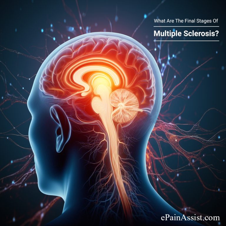 What Are The Final Stages Of Multiple Sclerosis?