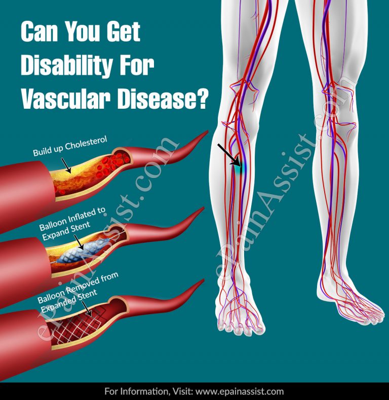 Can You Get Disability For Vascular Disease?