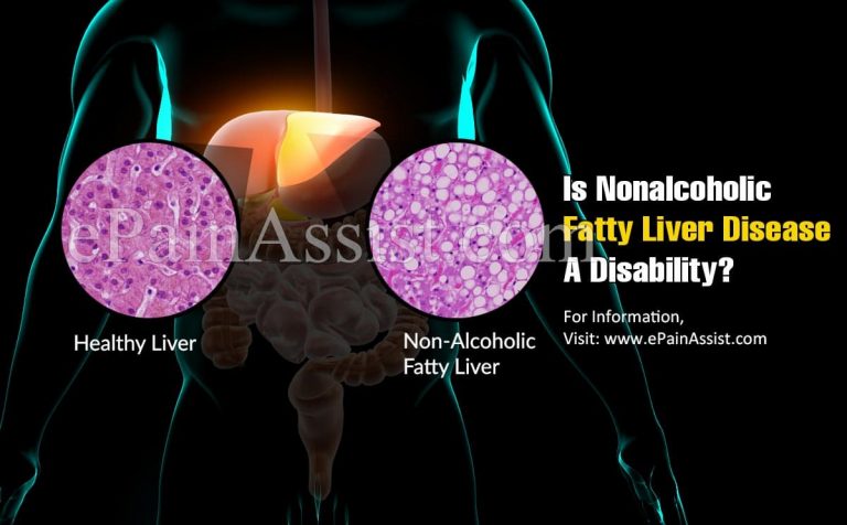 Is Nonalcoholic Fatty Liver Disease A Disability?