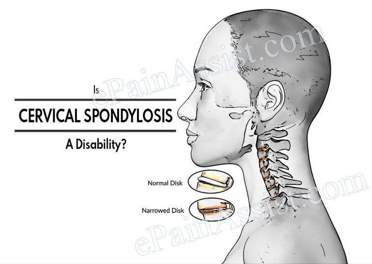 Is Cervical Spondylosis A Disability & Life Expectancy Of Someone With It?