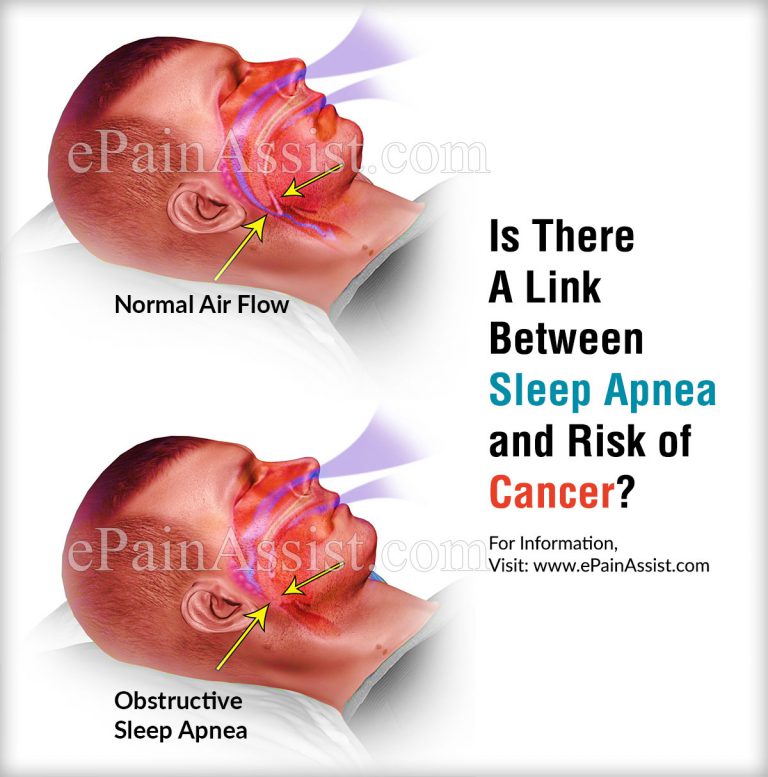 Is There A Link Between Sleep Apnea and Risk of Cancer?