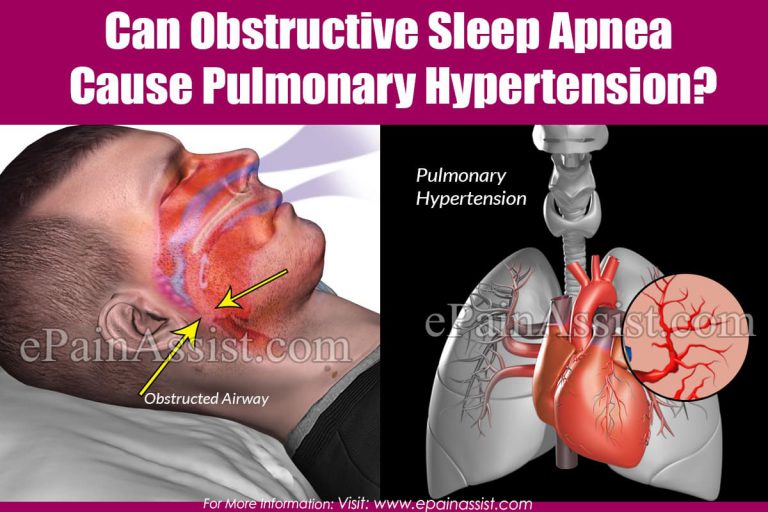 Can Obstructive Sleep Apnea Cause Pulmonary Hypertension?