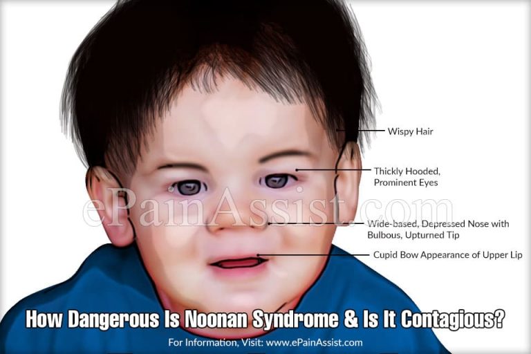 How Dangerous Is Noonan Syndrome & Is It Contagious?