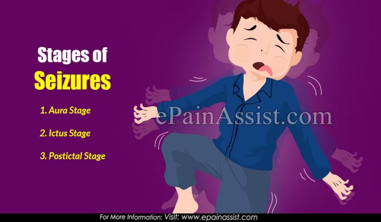 Stages of Seizures: Aura, Ictus, Postictal