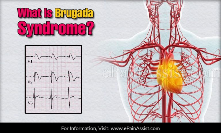 Brugada Syndrome
