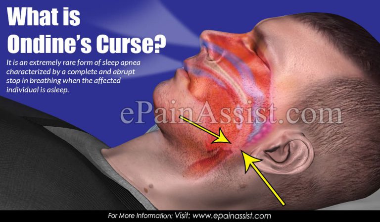What is Ondine’s Curse: Causes, Symptoms, Treatment