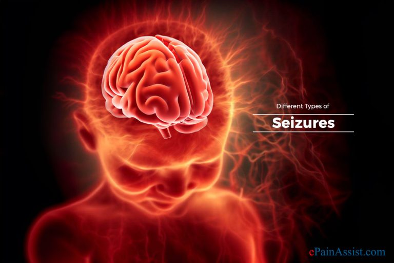 Different Types of Seizures