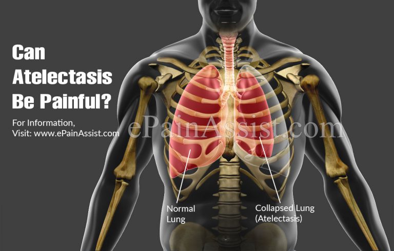Can Atelectasis Be Painful?