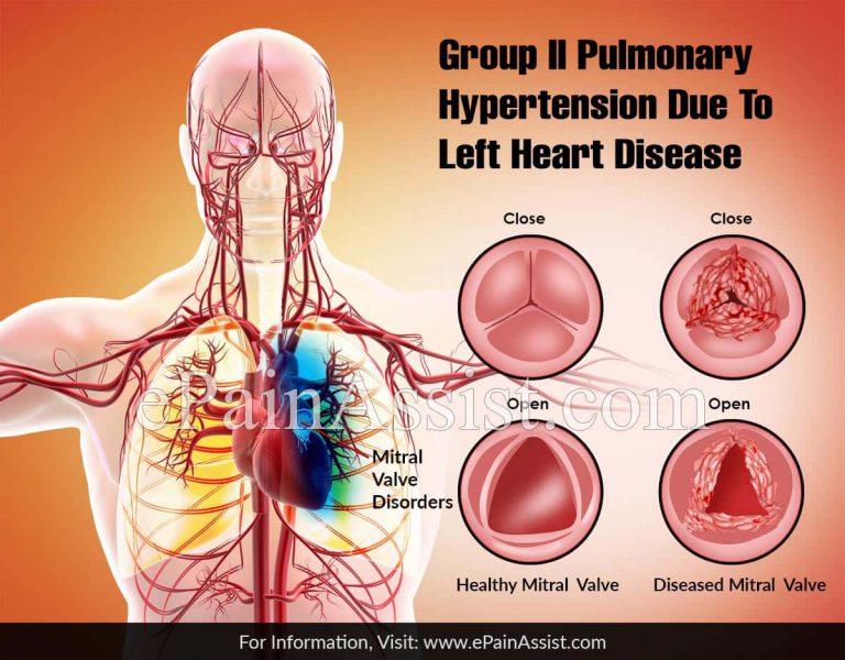 Group II Pulmonary Hypertension Due To Left Heart Disease