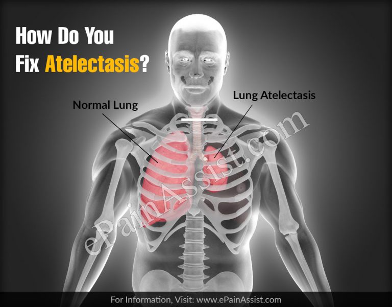 How Do You Fix Atelectasis?