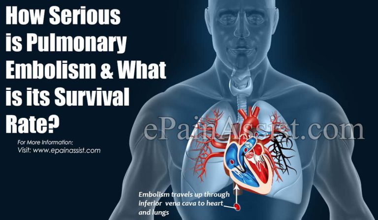 How Serious is Pulmonary Embolism & What is its Survival Rate?