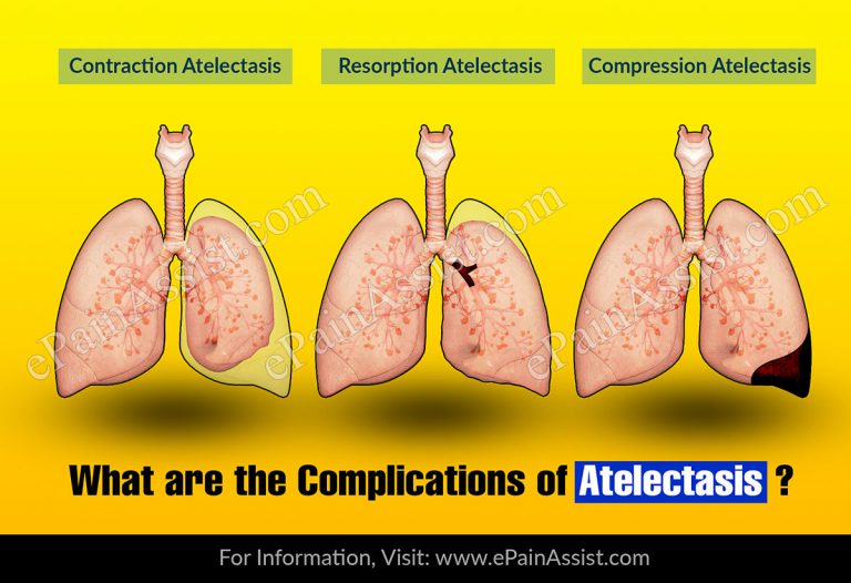 What Are The Complications Of Atelectasis?