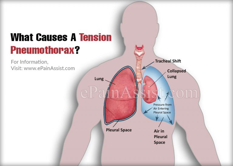 What Causes A Tension Pneumothorax?