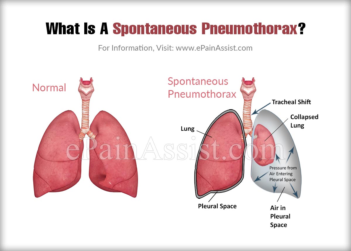 What Is A Spontaneous Pneumothorax?