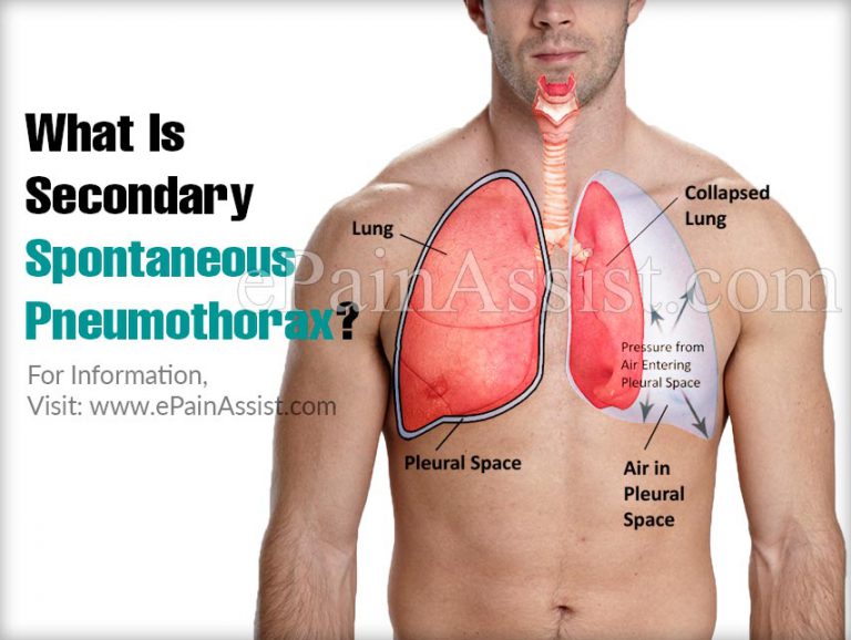 What Is Secondary Spontaneous Pneumothorax?