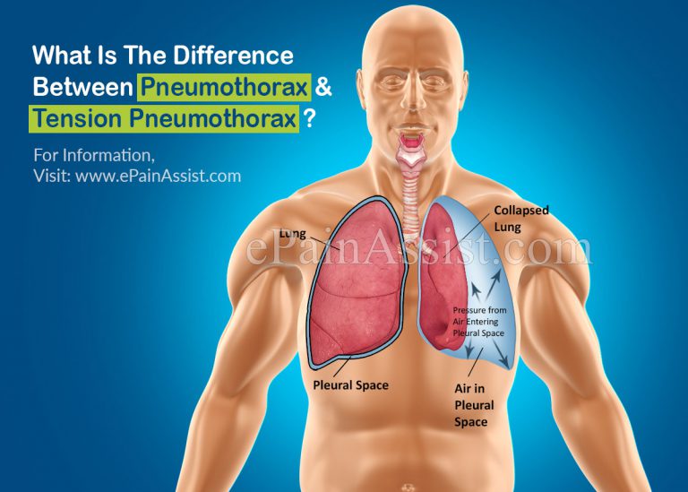 What Is The Difference Between Pneumothorax And Tension Pneumothorax?