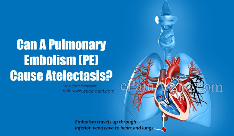 Can A Pulmonary Embolism (PE) Cause Atelectasis?