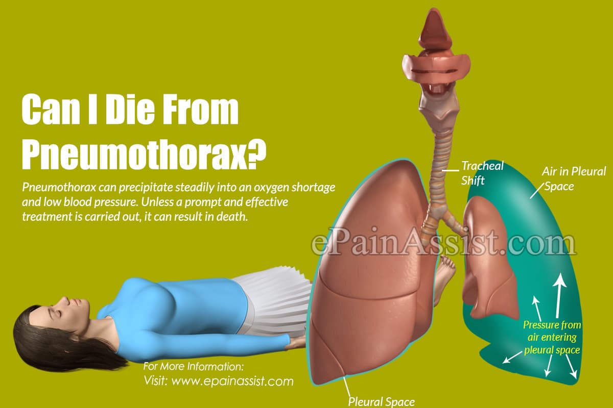 Can I Die From Pneumothorax?