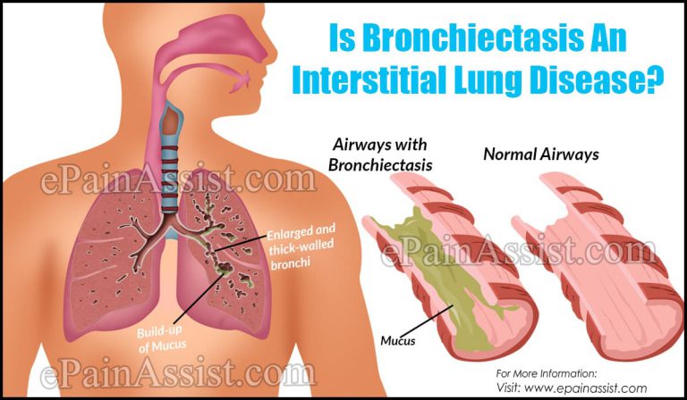 Is Bronchiectasis An Interstitial Lung Disease?