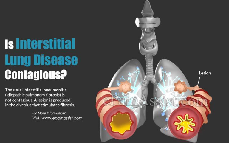 Is Interstitial Lung Disease Contagious?