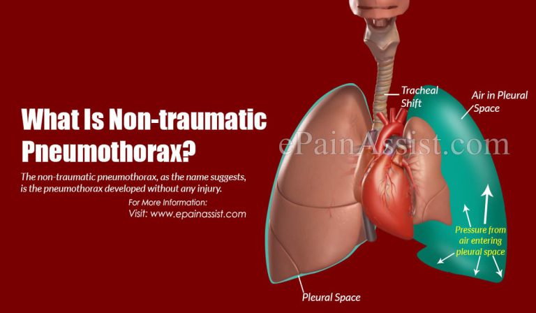 What Is Non-traumatic Pneumothorax?