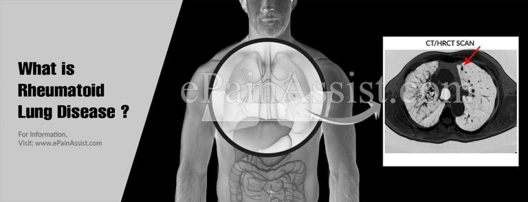 What Are The Presenting Features Of Rheumatoid Lung Disease & How Is It Treated?