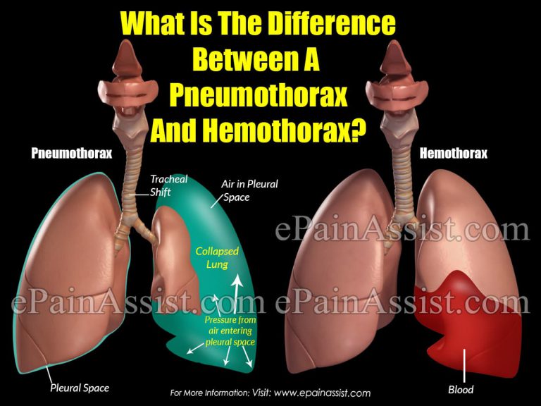 What Is The Difference Between A Pneumothorax And Hemothorax?