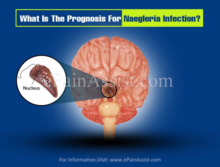 What Is The Prognosis For Naegleria Infection?