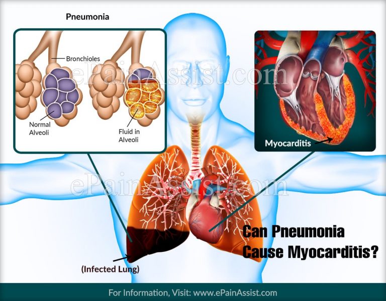 Can Pneumonia Cause Myocarditis?