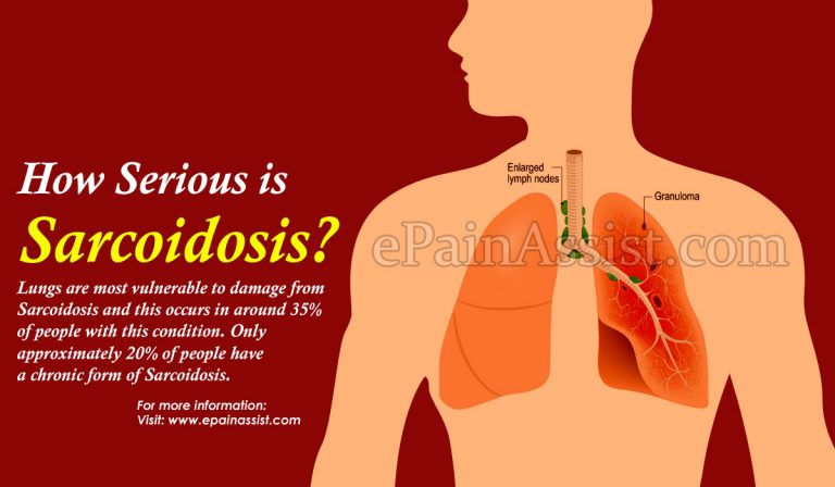 How Serious is Sarcoidosis?