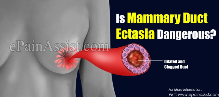 Is Mammary Duct Ectasia Dangerous?