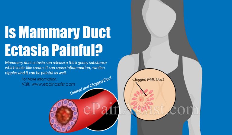 Is Mammary Duct Ectasia Painful?