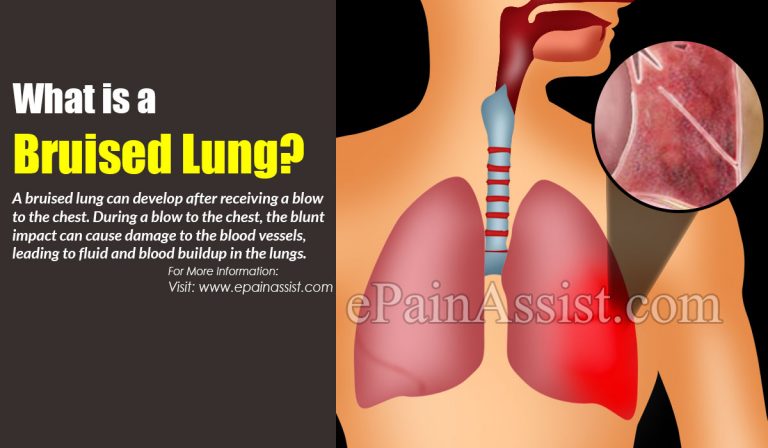 What is Bruised Lung or Pulmonary Contusion & How is it Treated? Causes, Symptoms of Bruised Lung